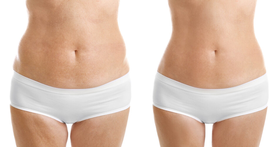 Debunking Common Myths About Liposuction Procedures