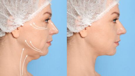 How to Recovery Quicker After a Neck Lift Procedure