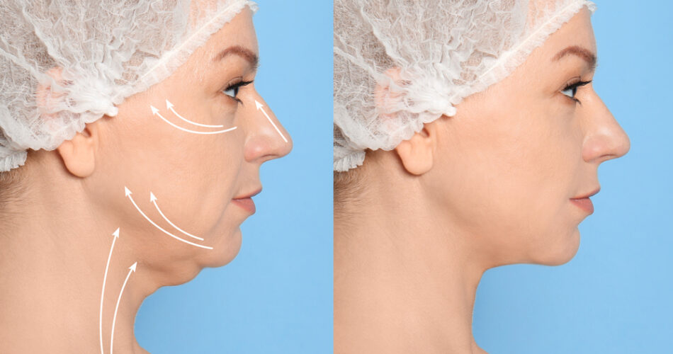 How to Recovery Quicker After a Neck Lift Procedure