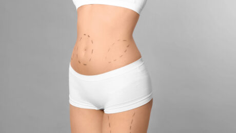 What is a Mini Tummy Tuck? A Comprehensive Guide