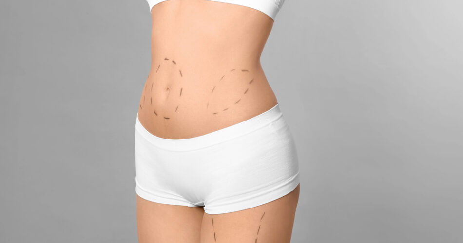 What is a Mini Tummy Tuck? A Comprehensive Guide