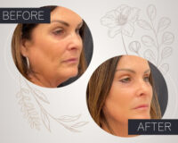 V-Lift in South Florida: Your Anti-Aging Solution