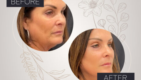 V-Lift in South Florida: Your Anti-Aging Solution