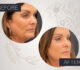 V-Lift in South Florida: Your Anti-Aging Solution