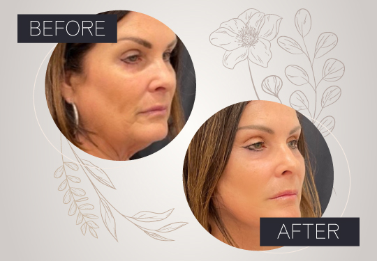 V-Lift in South Florida: Your Anti-Aging Solution