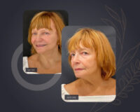 Rejuvenate Your Appearance with the V-Lift Procedure