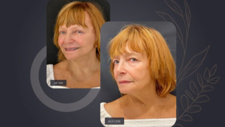 Rejuvenate Your Appearance with the V-Lift Procedure