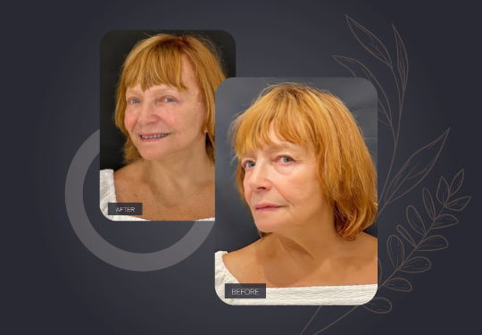 Rejuvenate Your Appearance with the V-Lift Procedure