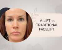 V-Lift vs. Traditional Facelift: Which Procedure is Right for You?