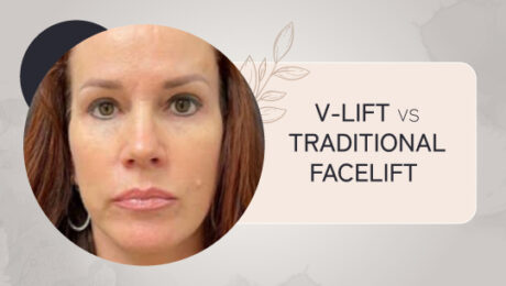 V-Lift vs. Traditional Facelift: Which Procedure is Right for You?