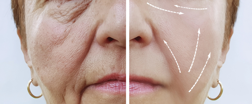 Rejuvenate Your Appearance with the V-Lift Procedure