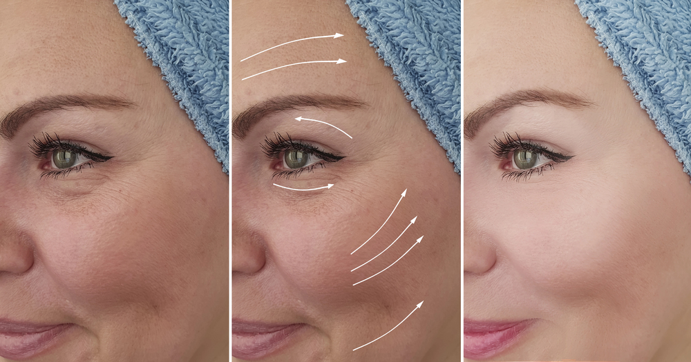 Rejuvenate Your Appearance with the V-Lift Procedure