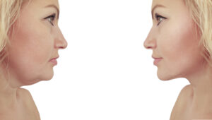 V-Lift vs. Traditional Facelift: Which Procedure is Right for You?