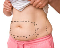 5 Questions to Ask Before Considering a Liposuction Procedure