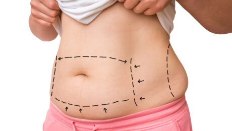 5 Questions to Ask Before Considering a Liposuction Procedure