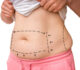 5 Questions to Ask Before Considering a Liposuction Procedure