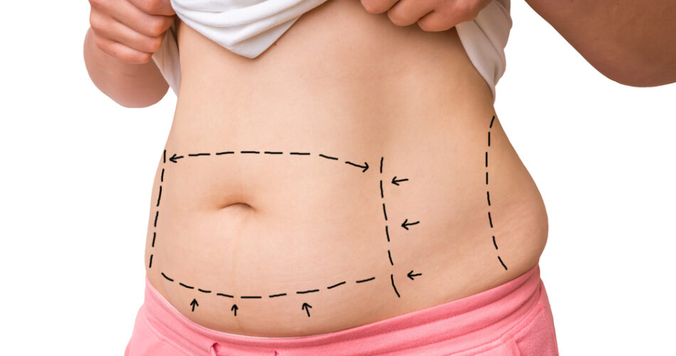 5 Questions to Ask Before Considering a Liposuction Procedure