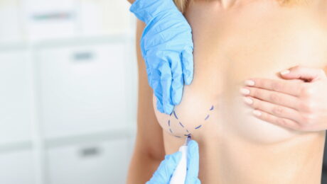 Breast VLift: A Less Invasive Approach to Breast Lifting