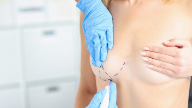 Breast VLift: A Less Invasive Approach to Breast Lifting